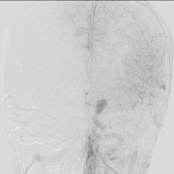 File:Cerebral aneurysm with rupture (Radiopaedia 29933-30458 LT ICA IC 19).jpg