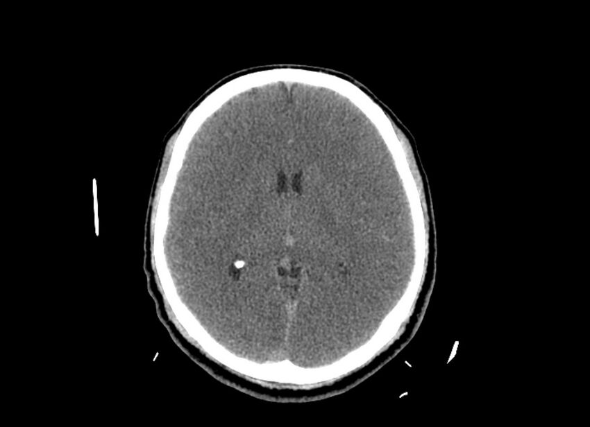 Cerebral edema (Radiopaedia 82519-96661 Axial non-contrast 26).jpg