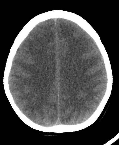 File:Cerebral edema due to severe hyponatremia (Radiopaedia 89826-106937 Axial non-contrast 63).jpg