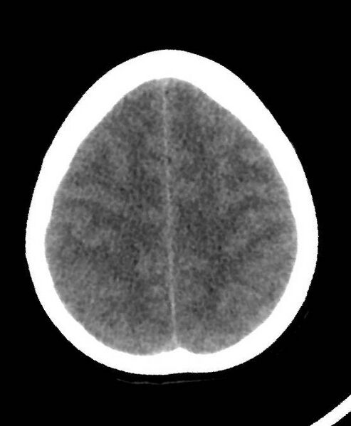 File:Cerebral edema due to severe hyponatremia (Radiopaedia 89826-106937 Axial non-contrast 73).jpg