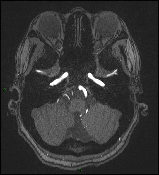 File:Cerebral fat embolism (Radiopaedia 35022-36525 Axial TOF 34).jpg