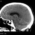 Cerebral hemorrhagic contusion with subdural and subarachnoid hemorrhage (Radiopaedia 10680-11146 C 9).jpg