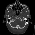 Cerebral hemorrhagic contusions (Radiopaedia 23145-23188 Axial bone window 7).jpg
