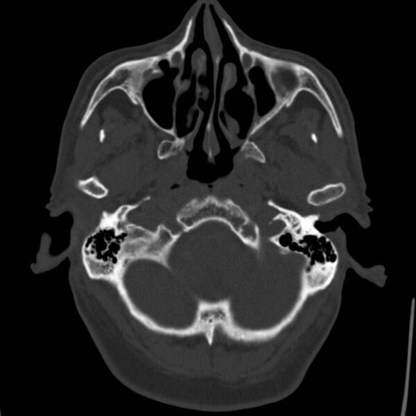 File:Cerebral hemorrhagic contusions (Radiopaedia 23145-23188 Axial bone window 7).jpg
