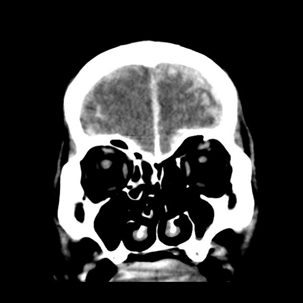 File:Cerebral hemorrhagic contusions (Radiopaedia 23145-23188 Coronal non-contrast 9).jpg