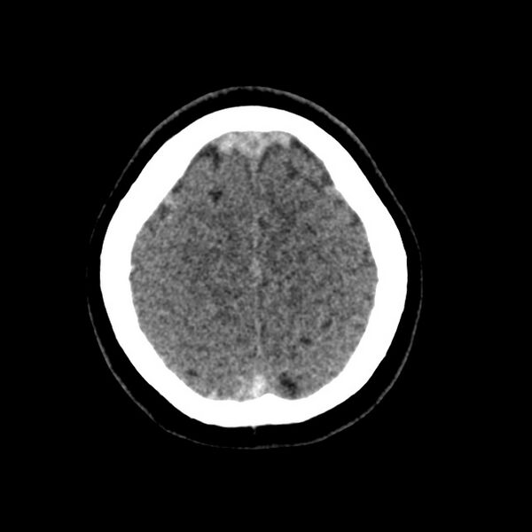 File:Cerebral venous sinus thrombosis (Radiopaedia 59224-66551 Axial non-contrast 43).jpg