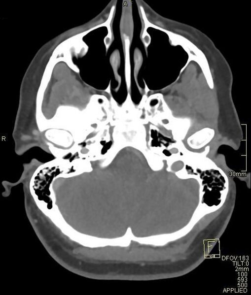 File:Cerebral venous sinus thrombosis (Radiopaedia 91329-108965 Axial venogram 18).jpg