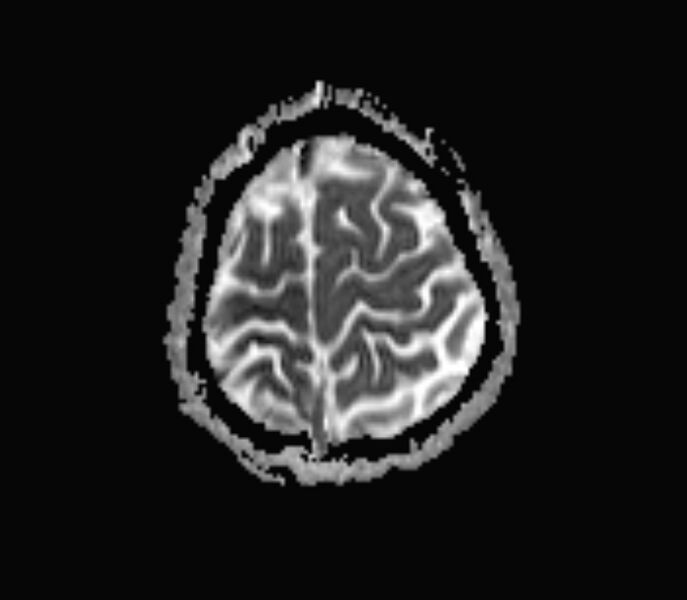 File:Cerebral venous thrombosis (Radiopaedia 71207-81504 Axial ADC 17).jpg