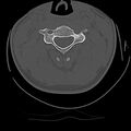 Cervical flexion teardrop fracture with cord hemorrhage (Radiopaedia 32497-33454 Axial bone window 34).jpg