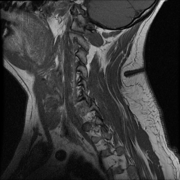 File:Cervical fracture and dislocation with locked facet (Radiopaedia 31837-32781 Sagittal T1 2).jpg