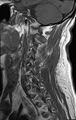 Cervical schwannoma (Radiopaedia 72399-82934 Sagittal T1 10).jpg
