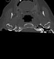 Cervical spine ACDF loosening (Radiopaedia 48998-54070 Axial bone window 3).png