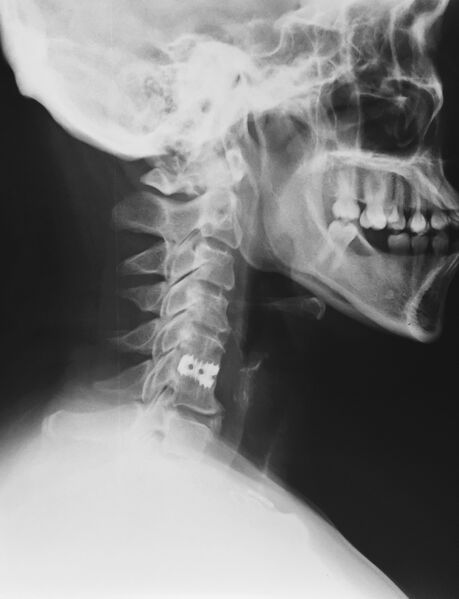 File:Cervical spine disc spacer (Radiopaedia 49612-54808 A 1).JPG