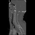 Cervical spine fractures with vertebral artery dissection (Radiopaedia 32135-33078 Sagittal bone window 22).jpg