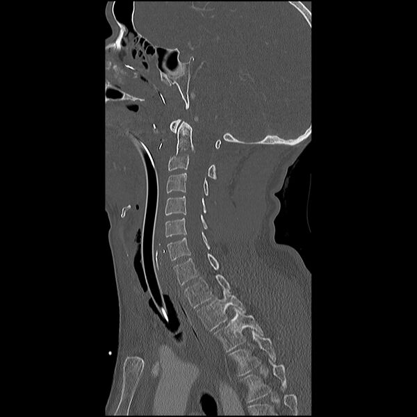 File:Cervical spine fractures with vertebral artery dissection (Radiopaedia 32135-33078 Sagittal bone window 22).jpg
