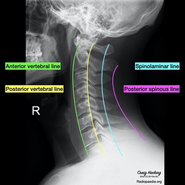 File:Cervical spine lines (Radiopaedia 76069-87571 B 1).jpeg