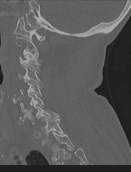 File:Cervical spondylolysis (Radiopaedia 49616-54811 Sagittal bone window 48).png