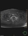 Cesarian scar endometriosis (Radiopaedia 68495-78066 Axial T1 C+ fat sat 19).jpg