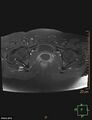 Cesarian scar endometriosis (Radiopaedia 68495-78066 Axial T1 C+ fat sat 21).jpg