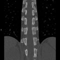 Chance fracture (Radiopaedia 36521-38081 Coronal bone window 33).jpg