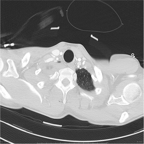 File:Chest and abdomen multi-trauma (Radiopaedia 26294-26425 lung window 14).jpg