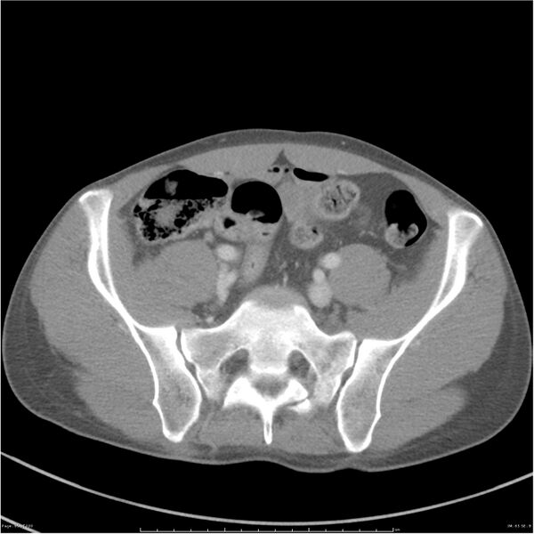 File:Chest and abdomen multi-trauma (Radiopaedia 26294-26426 bone window 65).jpg