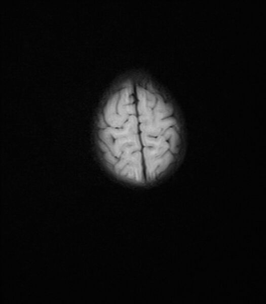 File:Chiari III malformation with occipital encephalocele (Radiopaedia 79446-92559 Axial FLAIR 23).jpg