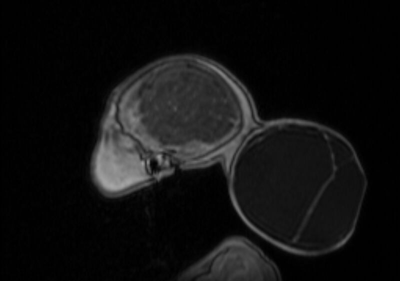 File:Chiari III malformation with occipital encephalocele (Radiopaedia 79446-92559 Sagittal T1 C+ mpr 15).jpg