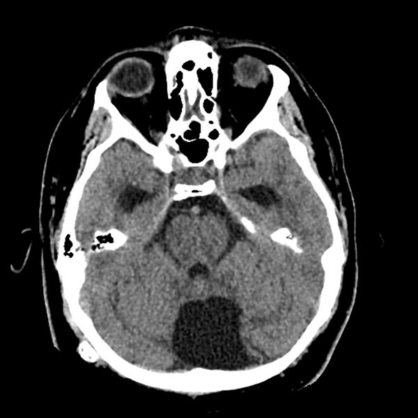 File:Chiasmatic-hypothalamic juvenile pilocytic astrocytoma (Radiopaedia 78533-91237 Axial non-contrast 20).jpg