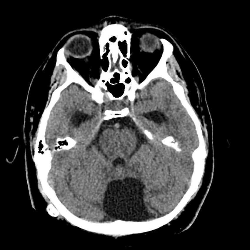 Chiasmatic-hypothalamic juvenile pilocytic astrocytoma (Radiopaedia 78533-91237 Axial non-contrast 20).jpg