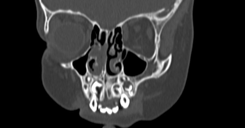 Choanal atresia (Radiopaedia 51295-56972 Coronal bone window 22).jpg