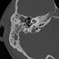 Cholesteatoma (Radiopaedia 15846-15494 bone window 15).jpg