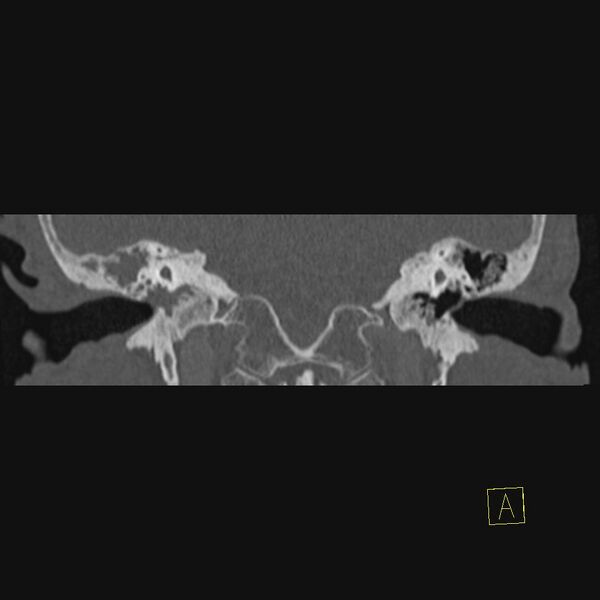 File:Cholesteatomatous chronic otitis (Radiopaedia 14993-14911 Coronal bone window 5).JPEG