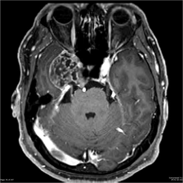 File:Chondrosarcoma of skull base- grade II (Radiopaedia 40948-43654 Axial T1 C+ 29).jpg