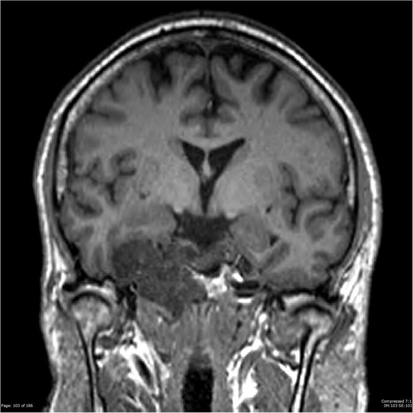 Chondrosarcoma of skull base- grade II (Radiopaedia 40948-43654 Coronal T1 24).jpg