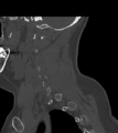 Chordoma (C4 vertebra) (Radiopaedia 47561-52188 Sagittal bone window 21).png