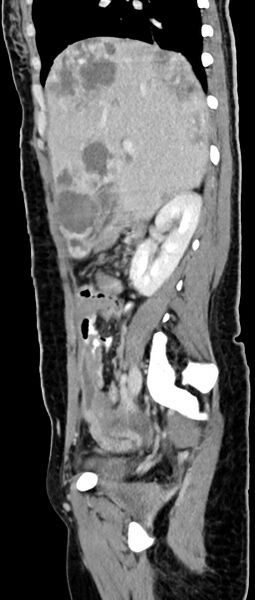 File:Choriocarcinoma liver metastases (Radiopaedia 74768-85766 C 119).jpg