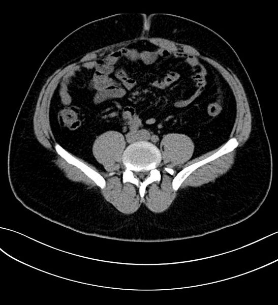 File:Chromophobe renal cell carcinoma (Radiopaedia 84286-99573 Axial non-contrast 38).jpg
