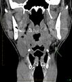 Chronic Submandibular sialolithiasis (Radiopaedia 16880-16606 non-contrast 1).jpg
