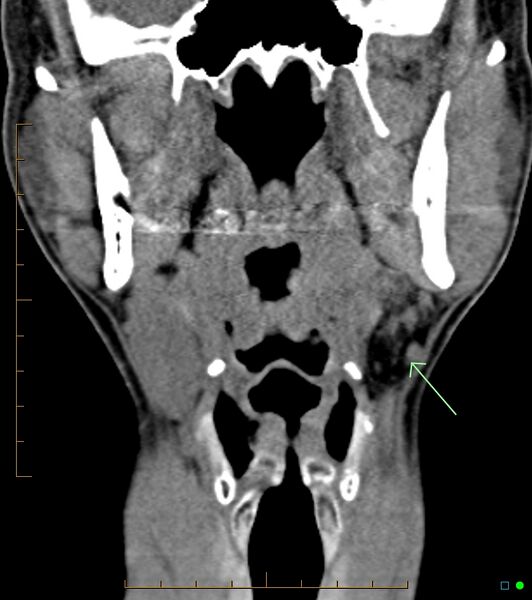 File:Chronic Submandibular sialolithiasis (Radiopaedia 16880-16606 non-contrast 1).jpg