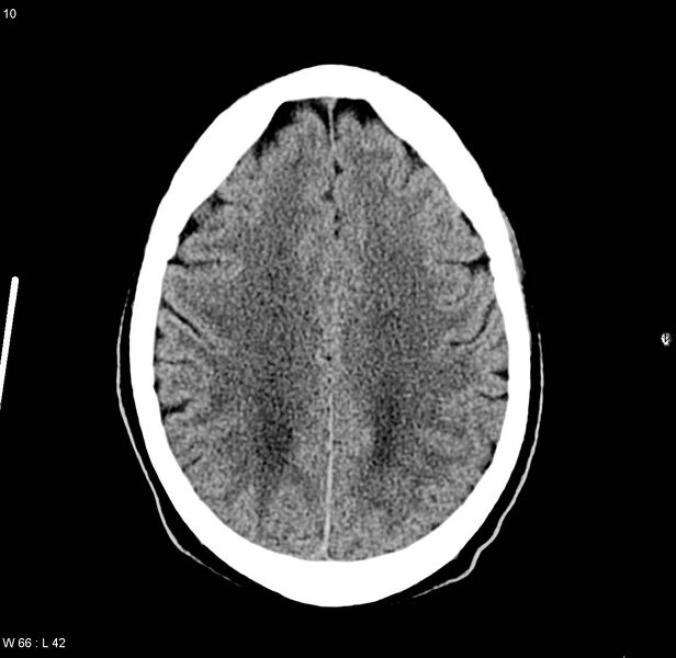 File:Chronic hypertensive encephalopathy (Radiopaedia 4564-6685 Axial non-contrast 1).jpg