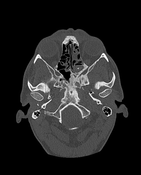 File:Chronic maxillary sinusitis caused by a foreign body (Radiopaedia 58521-65676 Axial bone window 192).jpg