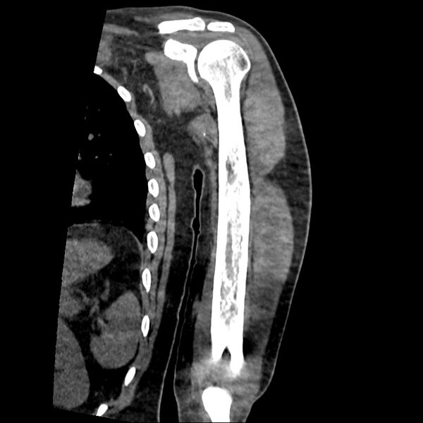File:Chronic osteomyelitis (Radiopaedia 67597-76998 Coronal Soft tissue 11).jpg