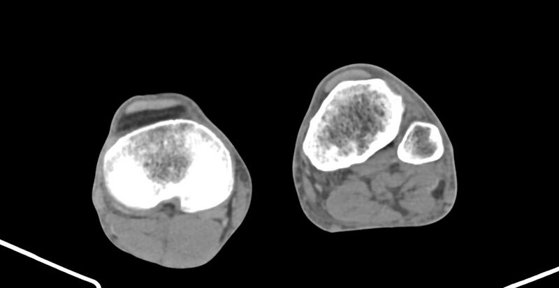 File:Chronic osteomyelitis (with sequestrum) (Radiopaedia 74813-85822 D 199).jpg