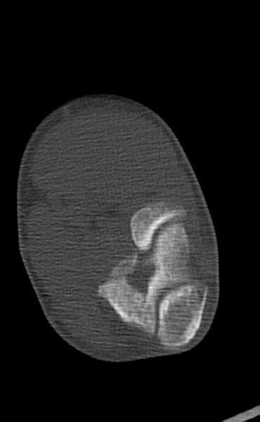 File:Chronic osteomyelitis of the distal humerus (Radiopaedia 78351-90971 Axial 48).jpg
