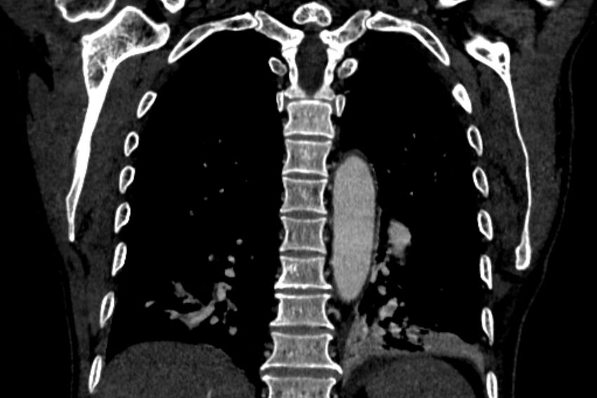 Chronic pulmonary embolism with bubbly consolidation (Radiopaedia 91248-108850 B 105).jpg