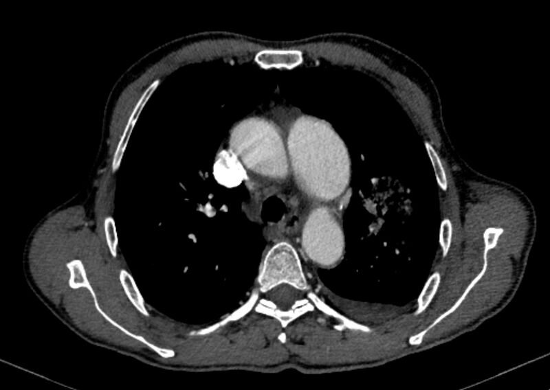 File:Chronic pulmonary embolism with bubbly consolidation (Radiopaedia 91248-108850 C+ arterial phase 46).jpg
