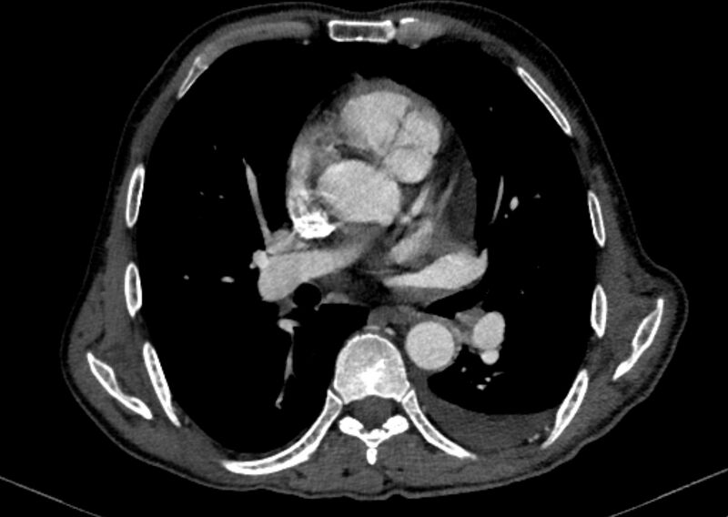 File:Chronic pulmonary embolism with bubbly consolidation (Radiopaedia 91248-108850 C+ arterial phase 78).jpg