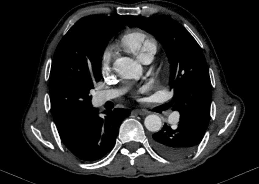 Chronic pulmonary embolism with bubbly consolidation (Radiopaedia 91248-108850 C+ arterial phase 78).jpg