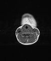 Chronic reactive multifocal osteomyelitis (CRMO) - mandible (Radiopaedia 56405-63069 Axial T1 3).jpg